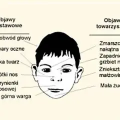 Ilustracja przedstawia twarz dziecka z zaznaczonymi cechami charakterystycznymi dla zespołu FAS: mały obwód głowy, płaska twarz, krótki nos, wąska warga, zmarszczka nakątna, zapadnięty grzbiet nosa.