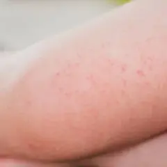 Szkarlatyna w przedszkolu - kiedy można wysłać dziecko?