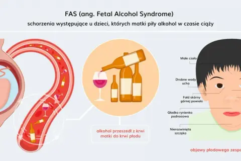 Ilustracja pokazuje, jak alkohol przechodzi z krwi matki do płodu, powodując alkoholowy zespół płodowy. Widoczne są charakterystyczne cechy twarzy dziecka, takie jak małe czoło, krótki nos i cienka górna warga.