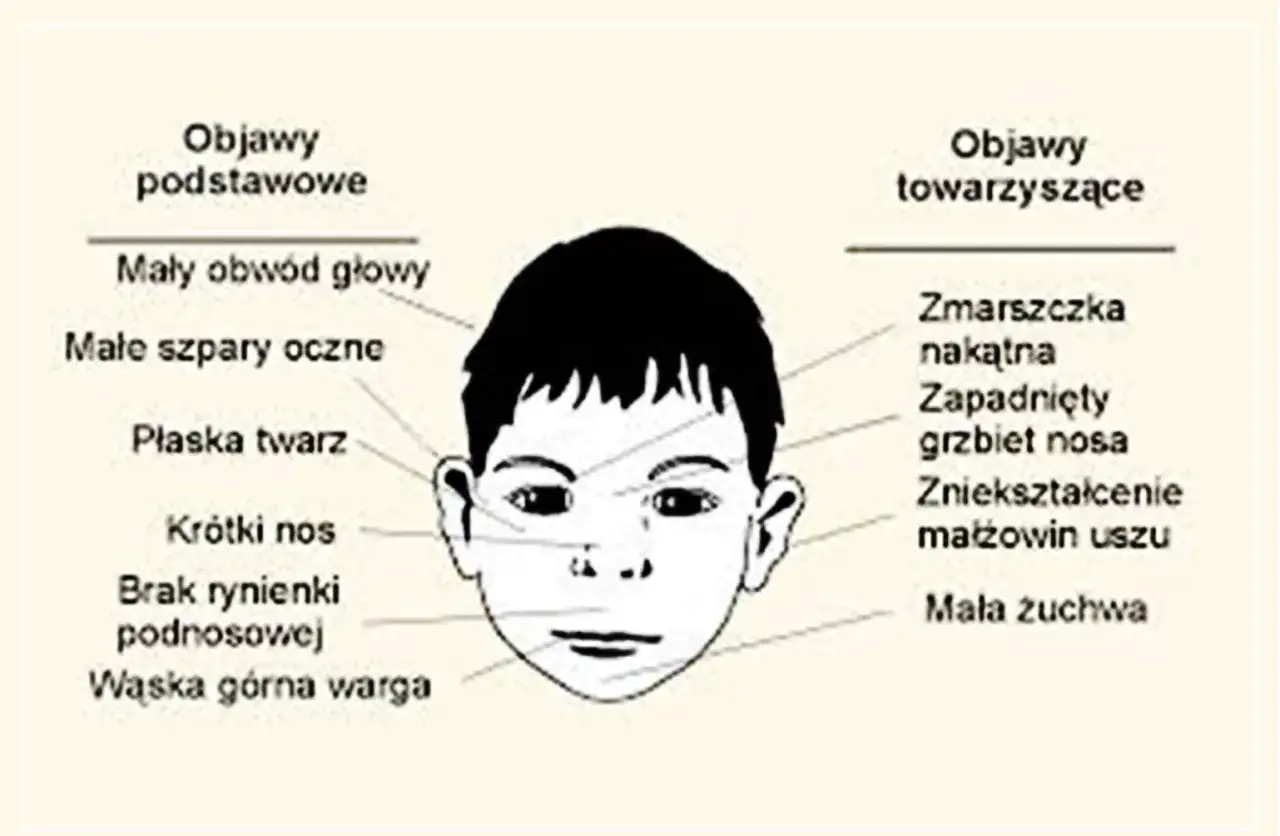 Ilustracja twarzy dziecka z zaznaczonymi objawami: mały obwód głowy, płaska twarz, krótki nos, wąska warga, zmarszczka nakątna, zniekształcone małżowiny uszu.