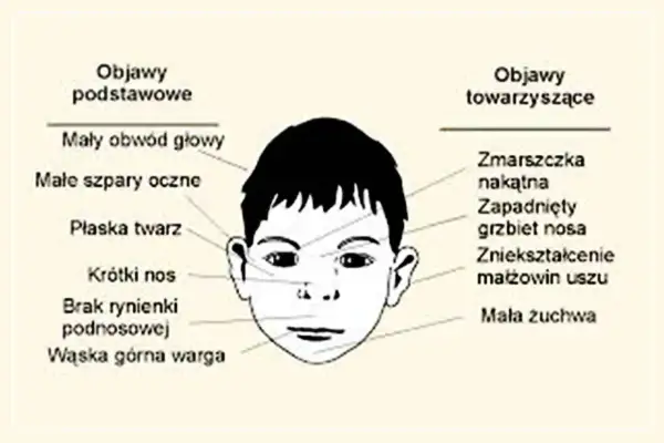 Ilustracja przedstawia twarz dziecka z zaznaczonymi cechami charakterystycznymi dla zespołu FAS: mały obwód głowy, płaska twarz, krótki nos, wąska warga, zmarszczka nakątna, zapadnięty grzbiet nosa.