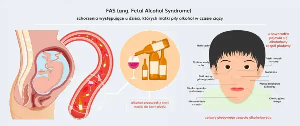 Ilustracja pokazuje, jak alkohol przechodzi z krwi matki do płodu, powodując alkoholowy zespół płodowy. Widoczne są charakterystyczne cechy twarzy dziecka, takie jak małe czoło, krótki nos i cienka górna warga.